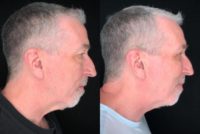 55-64 year old man treated with Neck Lift, Eyelid Surgery, Facial Fat Transfer
