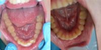 18-24 year old man treated with Invisalign