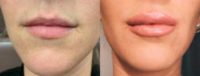 25-34 year old woman treated with Lip Injectable Fillers