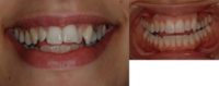 25-34 year old woman treated with Clear Braces