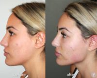 25-34 year old woman treated with Liquid Facelift