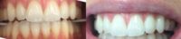 35-44 year old woman treated with Teeth Whitening