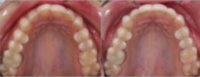 35-44 year old woman treated with Lingual Braces