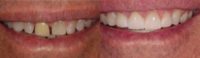 45-54 year old man treated with Porcelain Veneers