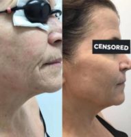 45-54 year old woman treated with IPL for the Reduction of Fine Lines and Wrinkles