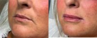 45-54 year old woman treated with Volbella