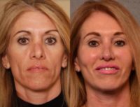 45-54 Year Old Woman Treated with Facelift