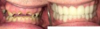 45-54 year old man treated with Snap-On Smile