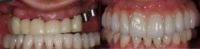 55-64 year old man treated with Dental Implants