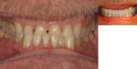 55-64 year old man treated with Smile Makeover