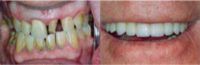 65-74 year old man treated with full mouth reconstruction