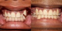 Braces Before and After Pictures