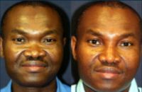 45 year old man treated with Injectable Fillers