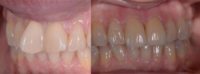 45-54 year old woman treated with Porcelain Veneers