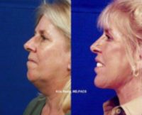 54 year old woman treated with Injectable Fillers