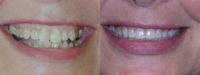 Invisalign Teeth Straightening