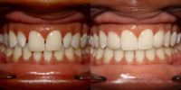 Veneers Before and After Pictures
