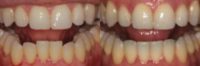38 year old man treated with Lingual Braces