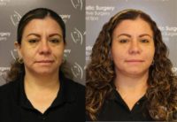 45-54 year old woman treated with Voluma