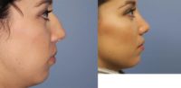 25 year-old Before/After Dorsal Rhinoplasty