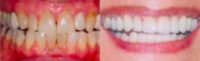 65-74 year old woman treated with Porcelain Veneers