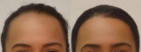 Woman treated with Forehead Reduction