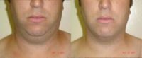 30 year old man treated with Laser Liposuction