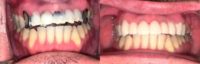 35-44 year old man treated with Dental Bridge