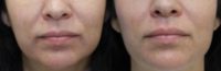 35-44 year old woman treated with Injectable Fillers (Liquid Facelift)