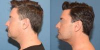 35-44 year old man treated with Chin Liposuction