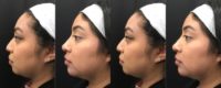 25 year old woman treated with Dermal Fillers