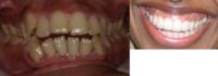Invisalign before and afters