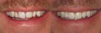 Tooth replacement in the smile