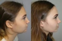 20 year old woman treated with Buccal Fat Removal
