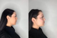 18-24 year old woman treated with Lip, Cheek and Chin Augmentation