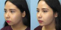 18-24 year old woman treated with Chin Implant