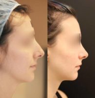 24 year old woman treated with Nose Surgery (aka Rhinoplasty)