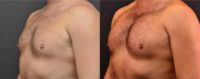 25-34 year old man treated with Pec Implants