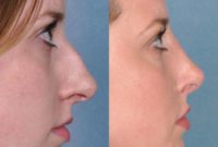 25-34 year old patient treated with Rhinoplasty