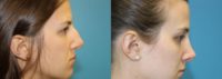 25-34 year old woman treated with Septo-rhinoplasty