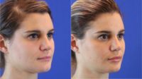 29 year-old female had injectable fillers to the cheeks and lips.