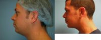 33 year old man treated with Chin Surgery
