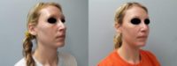 33 year old woman treated with Rhinoplasty