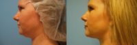 34 year old woman treated with Chin Surgery