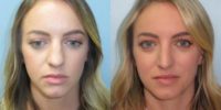 25-34 year old woman treated with Rhinoplasty