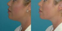 34 year old woman treated with Chin Liposuction