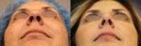 34 year old woman treated with Nose Surgery (aka Rhinoplasty)