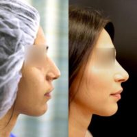36 year old woman treated with Nose Surgery