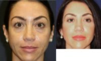 40 year old woman treated with Cheek Augmentation
