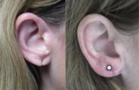 35-44 year old woman treated with Ear Lobe Surgery